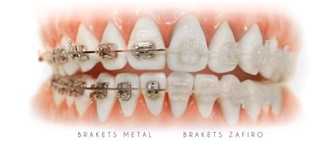 brackets zafiro y metalicos|brackets de zafiro metal.